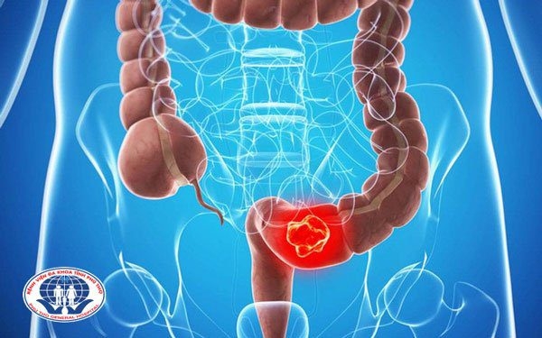 Ung thư trực tràng – Những tín hiệu bị bỏ quên